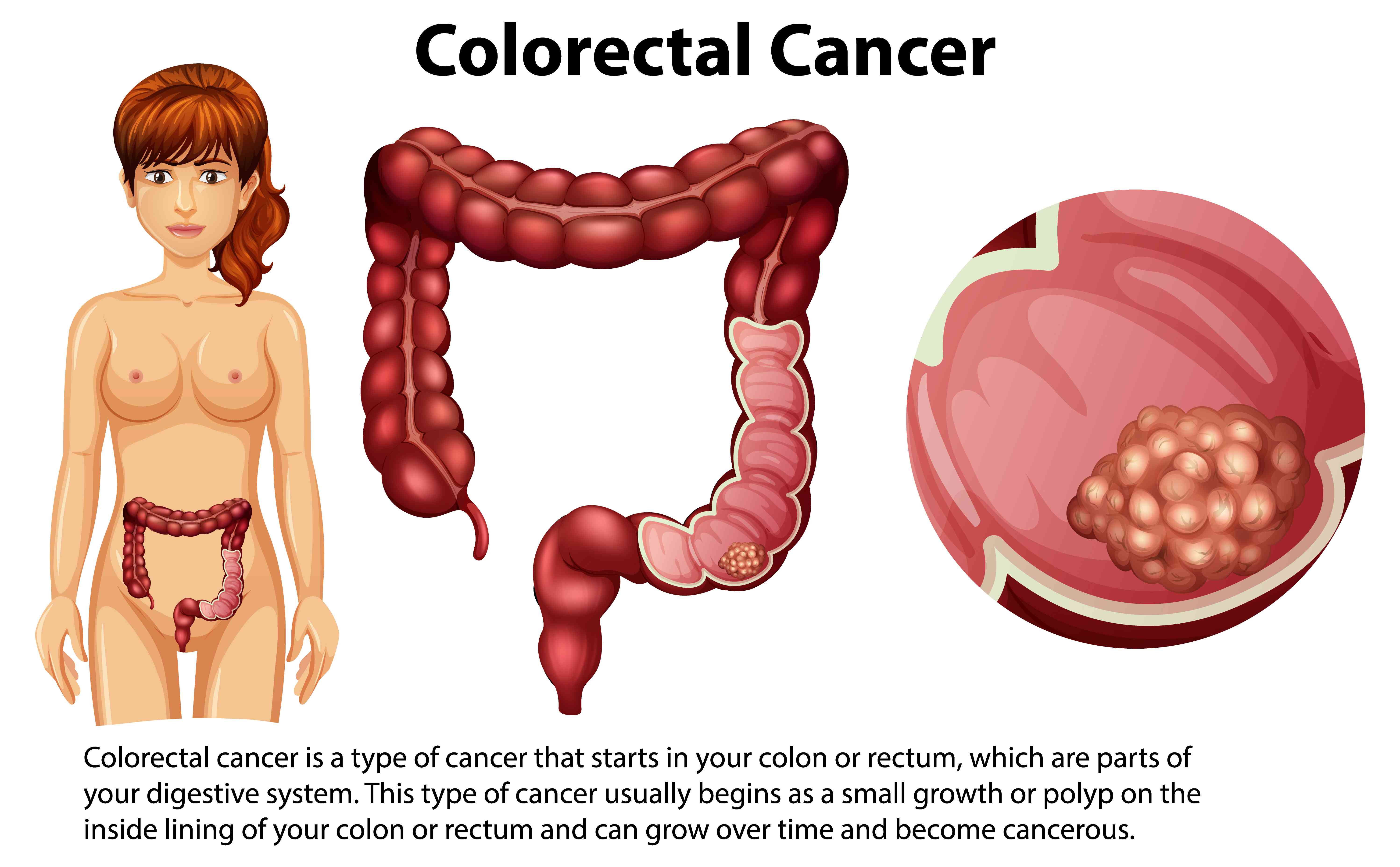 colerectal cancer