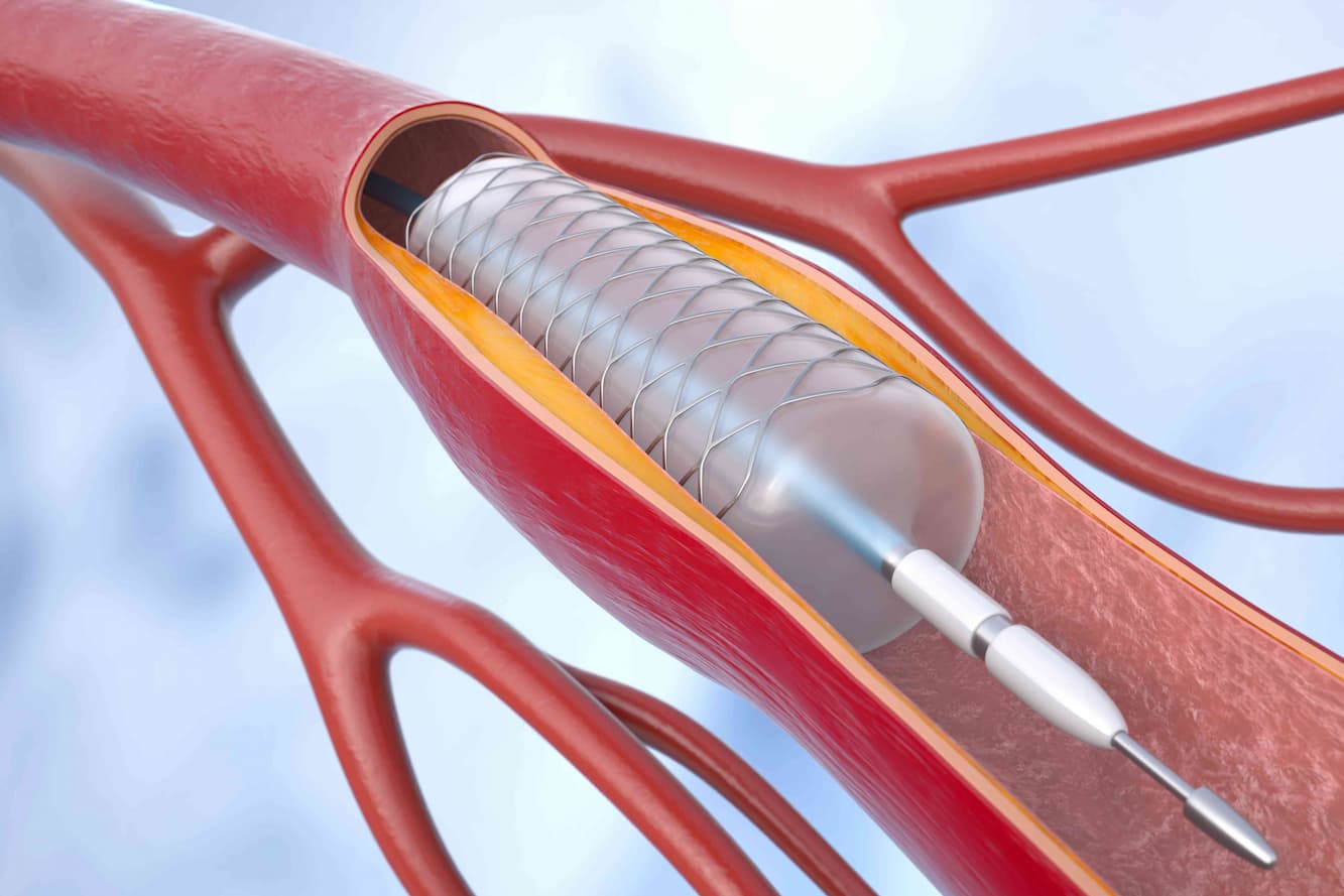 Coronary Angioplasty Treatment
