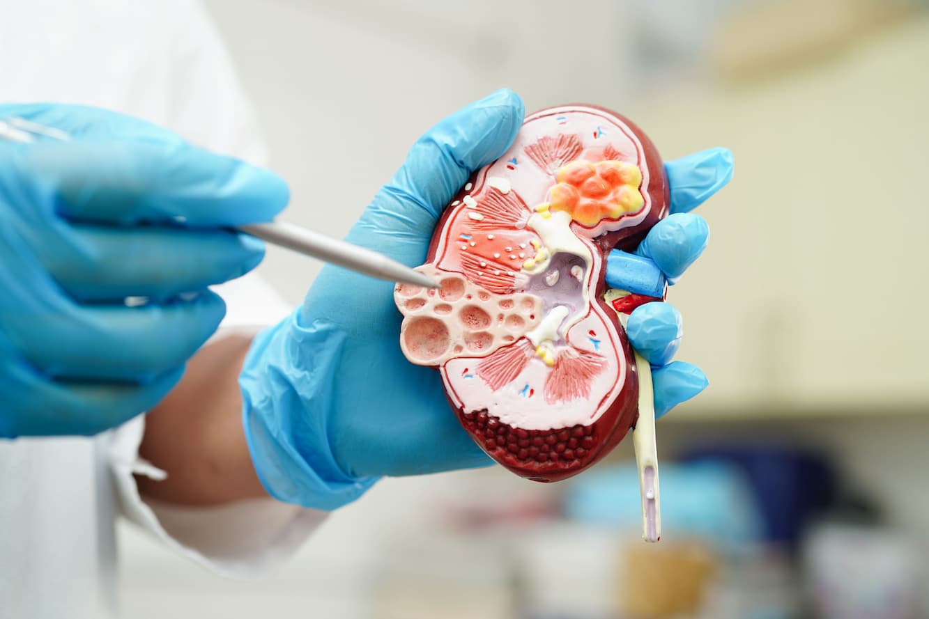 Kidney Transplant - Medvoyage