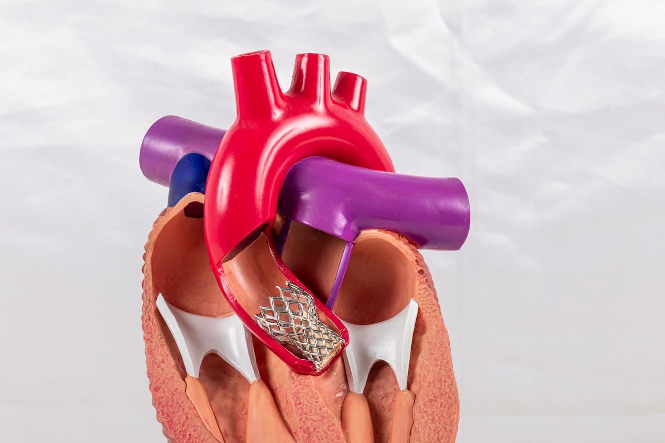 Transcatheter Aortic Valve Replacement (TAVR)